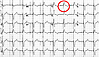 Schrittmacher-EKG