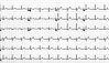 Normal-EKG einer herzgesunden jungen Frau