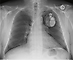 Röntgenbild eines Patienten mit CRT-D System (sog. 